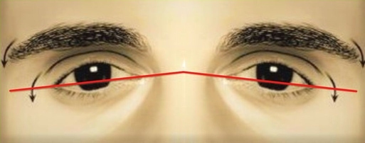 Negative Canthal Tilt